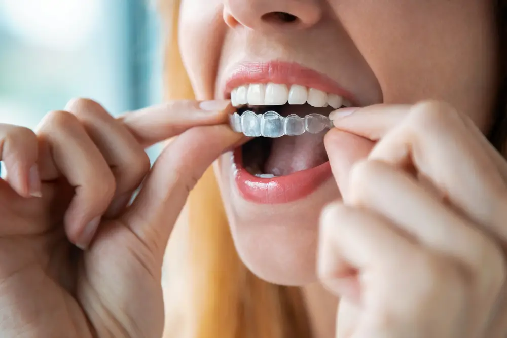 Selecting The Best Invisible Braces
